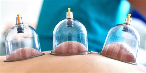 5 Easy Ways To Apply Cupping Therapy