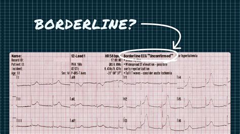 5 Signs Of A Borderline Ecg Result