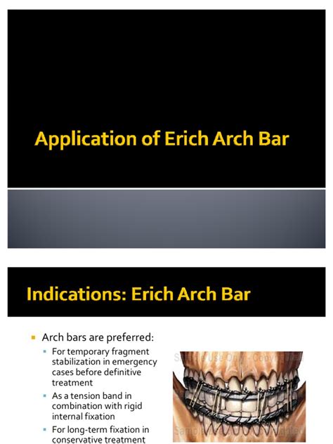 5 Steps To Master Arch Bar Application