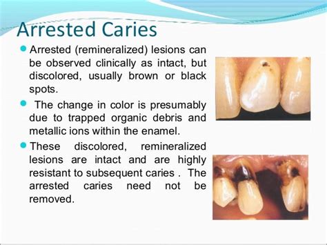 Arresting Tooth Decay With Interim Caries Medicament Application