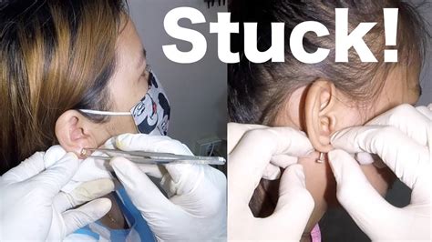 Earring Back Stuck Inside Ear: How To Remove Safely