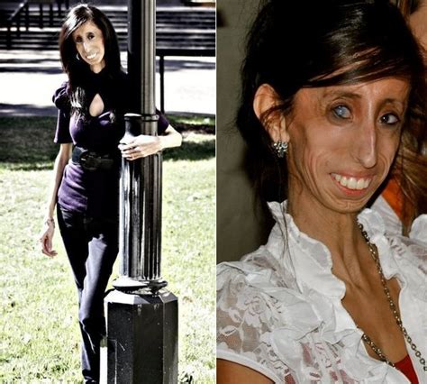 Meet Lizzie Velasquez: Worlds Skinniest Person