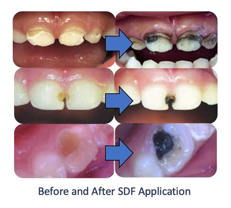 What Happens After Sdf Application In Dentistry